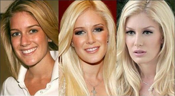 heidi montag surgery before after. Photo of Heidi Montag Before