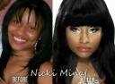 Photo of rapper Nicki Minaj - Before and After Cosmetic/Plastic Surgery